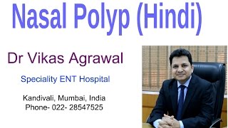 Nasal Polyps in Hindi by Dr Vikas Agrawal [upl. by Haerr733]