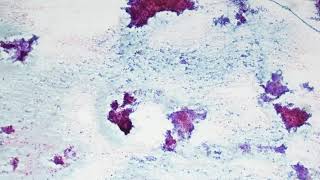 Pleomorphic adenoma Cytology [upl. by Bachman]