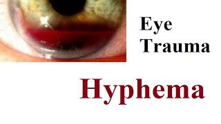 Hyphema [upl. by Egerton]