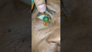 Bacterial corneal ulcer c leaucoma opacity in cornea surface loss off vision in Both eye [upl. by Ordnazil]