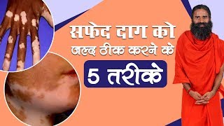 सफेद दाग White Spots को जल्द ठीक करने के 5 तरीके  Swami Ramdev [upl. by Siuqaj239]