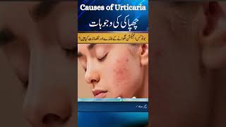 What Causes Urticaria Dr Atif Kazmi Explains Common Triggers [upl. by Augustin]