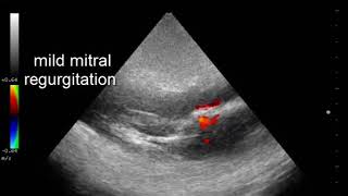 CASE 410 echo mild mitral regurgitation [upl. by Arlyne]