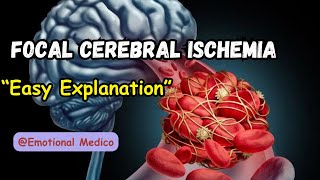 Focal cerebral ischemia  Ischemia and Infarction  CNS pathology  emotionalmedico [upl. by Atnod]