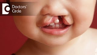 Surgeries for Cleft Lip amp Palate  Dr Srikanth V [upl. by Guttery]