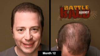 Bosley Hair Transplant Results After 12 Months Time Lapse [upl. by Nnaarual]