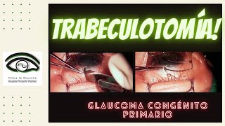 TRABECULOTOMÍA CLÍNICA DE GLAUCOMA HRRV 👀 👀 [upl. by Daffi636]