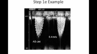 Intro to Aortic Stenosis [upl. by Nwadal23]