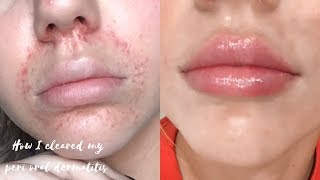 HOW I CLEARED MY PERIORAL DERMATITIS [upl. by Adnaerb48]