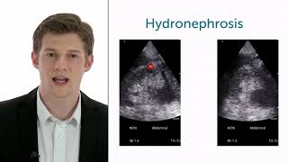 How To Evaluate Hydronephrosis In Point of Care Ultrasound [upl. by Ainecey]