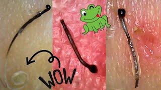 JUICY Hair Follicle Plucks  Satisfying Hair Root Extraction Under Microscope [upl. by Aisek945]