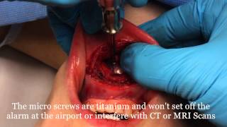 Silicone Chin Implants Made Easy Intraoral Approach inside the mouth by Dr Joe Niamtu III [upl. by Cassell186]