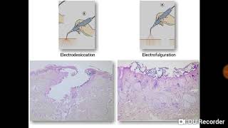 Essentials in Procedural Dermatology Part 1 Electrosurgery [upl. by Eixirt]