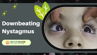 vertical eye movements  nystagmus  downbeat nystagmus nystagmus verticalnystagmus [upl. by Aniale]