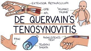 Understanding De Quervain’s Tenosynovitis Mummy Thumb [upl. by Natlus]