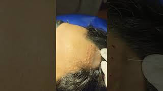 Steroid injection for Alopecia Areata [upl. by Enelyt754]