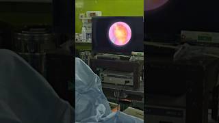 How ureteric stone look in endoscopy ureteralstone stone urs [upl. by Alur412]