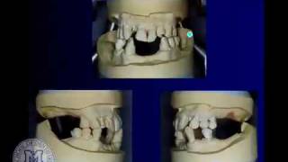 DENT 718 Tooth supported overdentures [upl. by Giesser159]