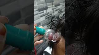 Hijama therapy for anxiety depression baldness etc [upl. by Kecaj]