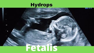 Hydrops Fetalis  Ultrasound  Anomaly  Case [upl. by Tenney319]