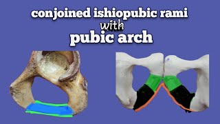 conjoined ishiopubic rami with pubic arch  lower limb of anatomy  Foziya Vohra amp Mukta Nivedita [upl. by Enilarac242]