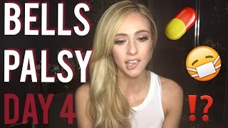 Bells Palsy Recovery and Home Remedies Ive been trying  Day 4 [upl. by Malinin140]