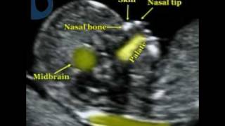 Fetal Medicine Foundation  Fetal profile [upl. by Epilif]