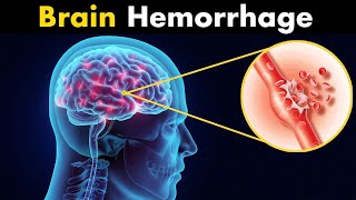 What Happens in Brain hemorrhage  Symptoms Causes and Treatment 3d animation [upl. by Oler]