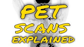 How do PET scans work to detect things such as cancer [upl. by Lawrence]