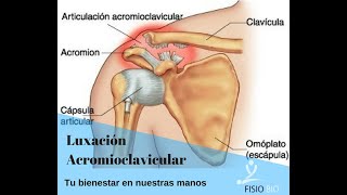 LUXACIÓN ACROMIO CLAVICULAR GRADO 2 [upl. by Tome]