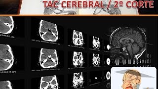 TAC CEREBRAL VIDEO 2 CORTE 2 [upl. by Brebner]