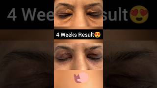 Xanthelasma Removal Before After  Xanthelasma Laser Removal Before and After [upl. by Cuda]