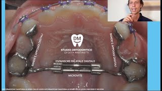 ORTODONZIA e TERAPIA INTERCETTIVA nel Bambino Palato stretto seconda classe Espansore Apparecchio [upl. by Armilla]