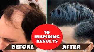 10 Impressive Hair Transplant Results Natural hairlines [upl. by Oiramej777]