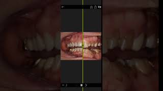 Invisalign Time Lapse Video [upl. by Sonitnatsnok]