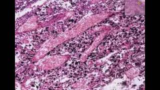 Histopathology Lymph nodeAnthracosis tuberculosis [upl. by Guillemette]