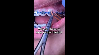 Why do I have to wear rubber bands Tooth Time Family Dentistry New Braunfels Texas [upl. by Lihcox]