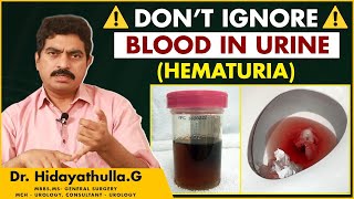 Causes of Haematuria  Symptoms and Causes of Blood in Urine Hindi  Dr Hidayatullah  TX Hospitals [upl. by Olav]