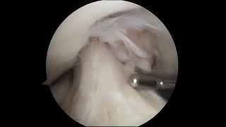 Torn Meniscus Arthroscopic Surgery [upl. by Cecilla]