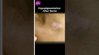 Hypopigmentation After Burn burnscar lasertreatment skintreatment shorts youtubeshorts [upl. by Llebpmac]