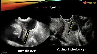 Gynaecological Ultrasound Step by Step Part 1 [upl. by Erwin]