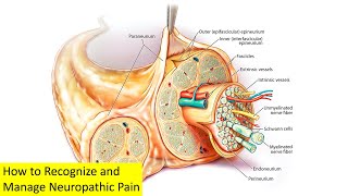 How to Recognize and Manage Neuropathic Pain [upl. by Reyotal]