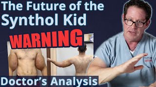 The Future of the Synthol Kid  Warning  Doctors Analysis [upl. by Atinehc]