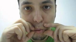 FACIAL PARESIS EXERCISE 6 AFTER ACOUSTIC NEUROMA SURGERY [upl. by Schach]