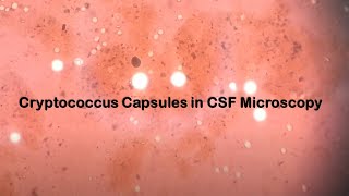 Cryptococcus Capsules in CSF Microscopy [upl. by Sualocin]