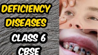 Deficiency diseases class 6 CBSE [upl. by Janel]