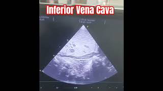 Neonatal Echocardiogram  Showing Inferior Vena Cava IVCvia subcostal view collapsible neonates [upl. by Prestige189]