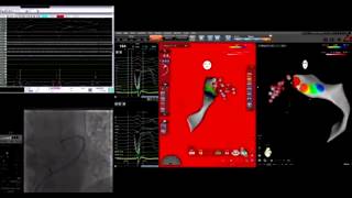 Great cardiac vein GCV VTAblation in coronarySinus EPStudy [upl. by Isaiah]