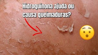 Melasma e as queimaduras causadas por hidroquinona😳 [upl. by Ridglea]