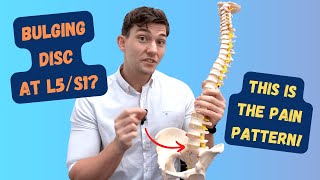 L5S1 Bulging Disc Pain Pattern Explained [upl. by Marchelle]